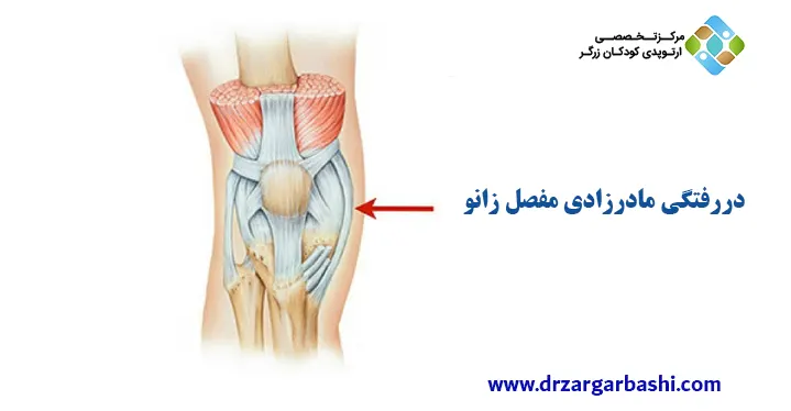 دررفتگی مادرزادی مفصل زانو