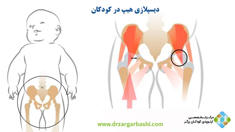دیسپلازی هیپ در کودکان