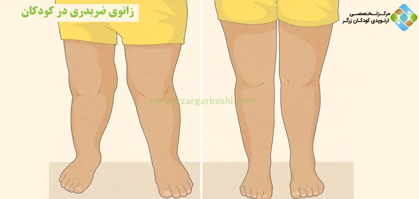 زانوی ضربدری در کودکان
