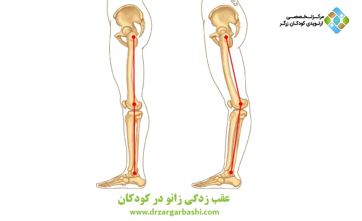 عقب زدگی زانو در کودکان