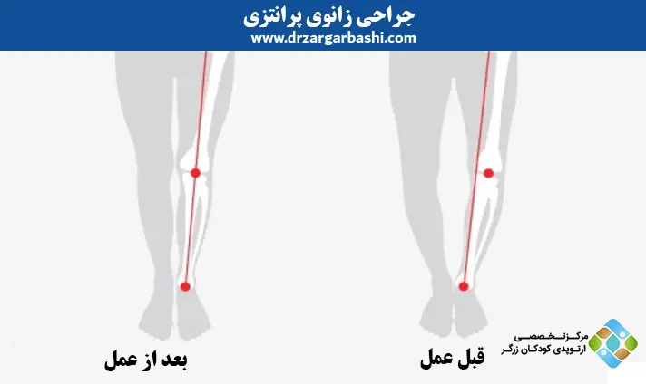 جراحی پای پرانتزی