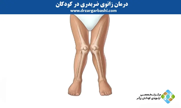 درمان زانوی ضربدری در کودکان