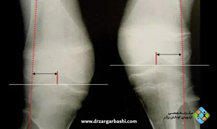 روش‌های درمان زانوی ضربدری در کودکان