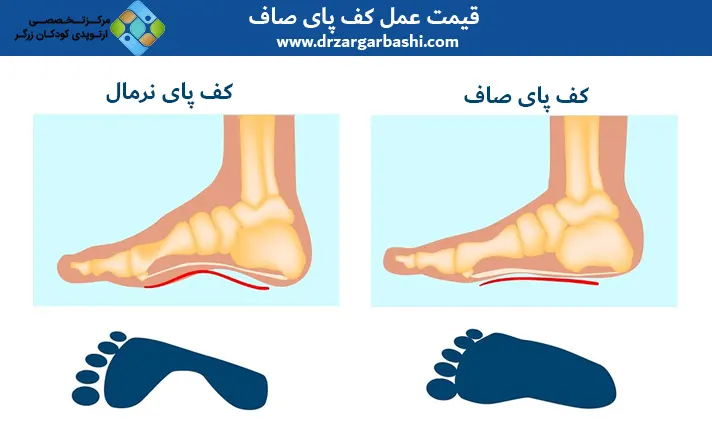 قیمت عمل کف پای صاف