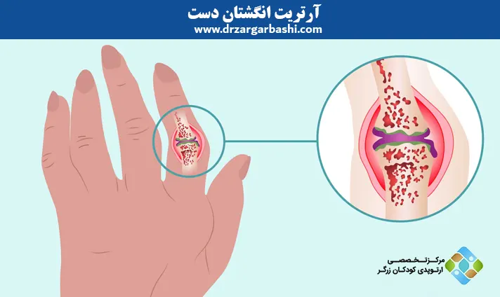 آرتریت انگشتان دست