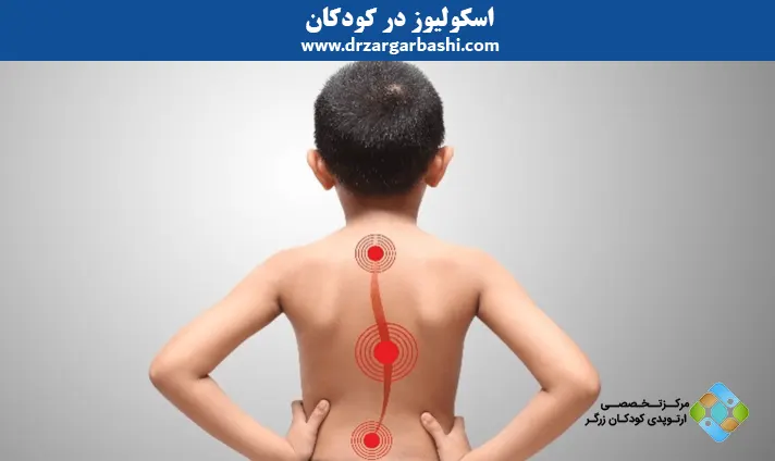 اسکولیوز در کودکان