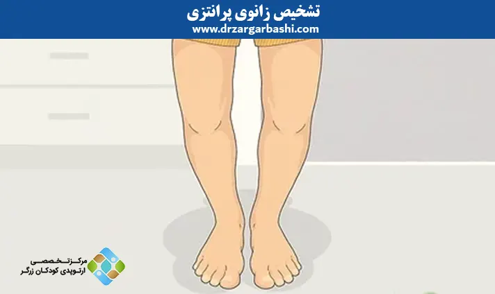 تشخیص زانوی پرانتزی