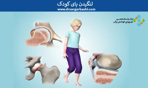 لنگیدن پای کودک