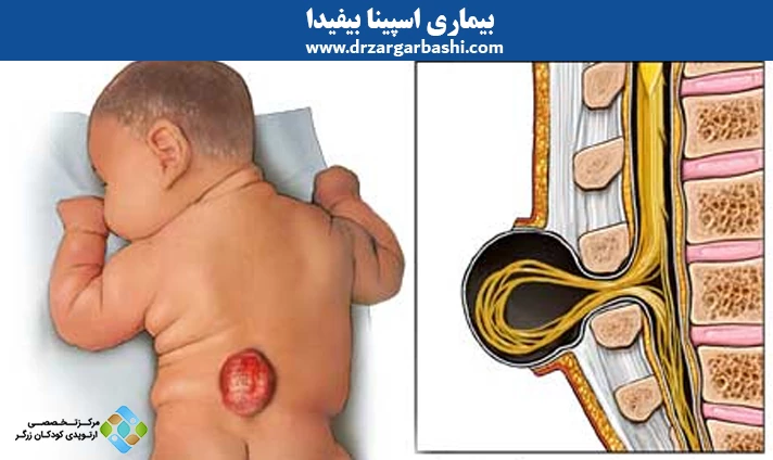 بیماری اسپینا بیفیدا