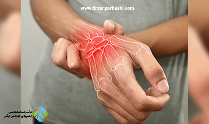 علل آرتریت روماتوئید نوجوانان