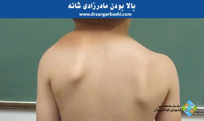 بالا بودن مادرزادی شانه