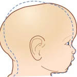 درمان بدشکلی جمجمه نوزاد