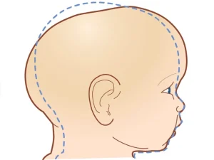 درمان بدشکلی جمجمه نوزاد