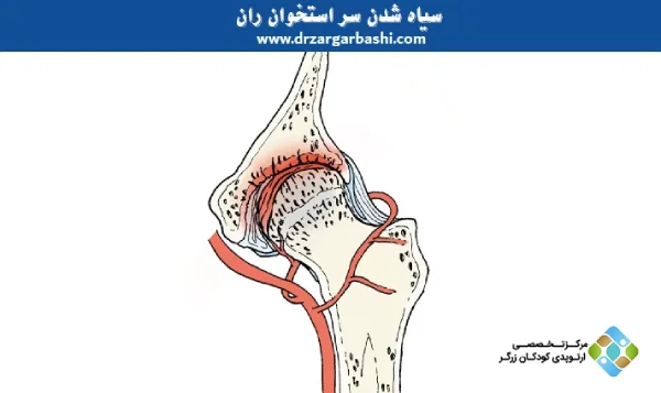 سیاه شدن سر استخوان ران