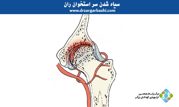 سیاه شدن سر استخوان ران