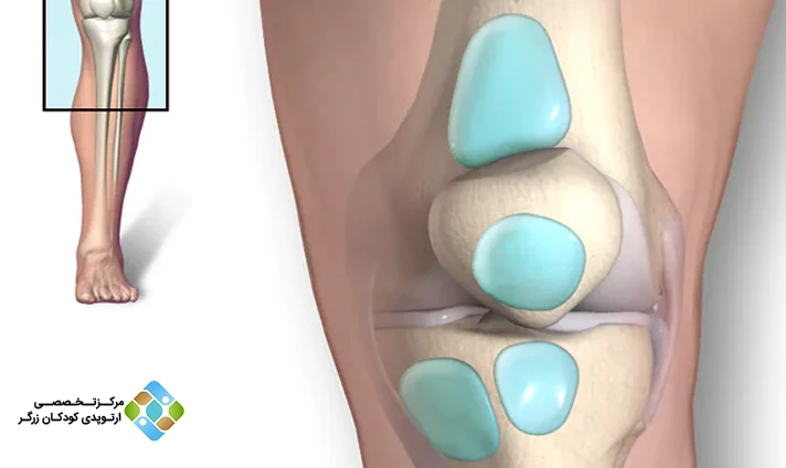 علائم بورسیت زانو