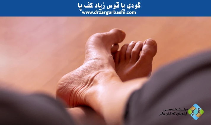 گودی یا قوس زیاد کف پا