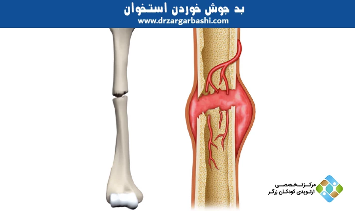 بد جوش خوردن استخوان