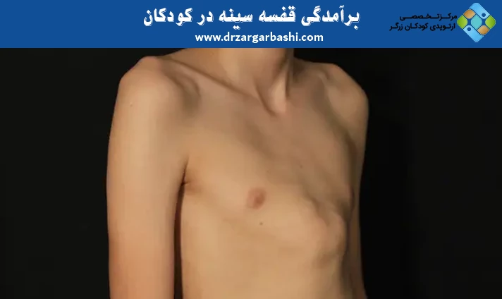 برآمدگی قفسه سینه در کودکان