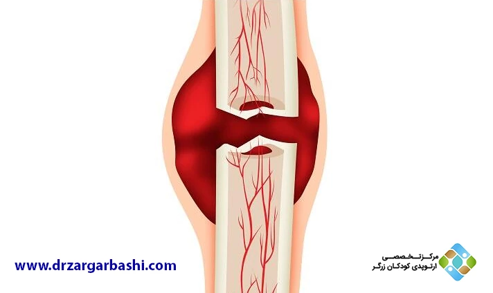 دلایل اصلی بد جوش خوردن استخوان