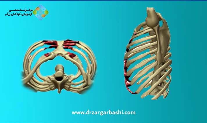 علائم سینه کبوتری در کودکان