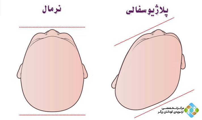 علائم صافی سر نوزاد