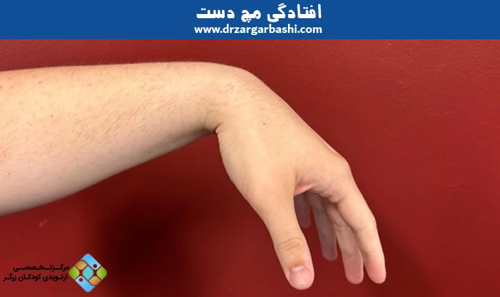افتادگی مچ دست