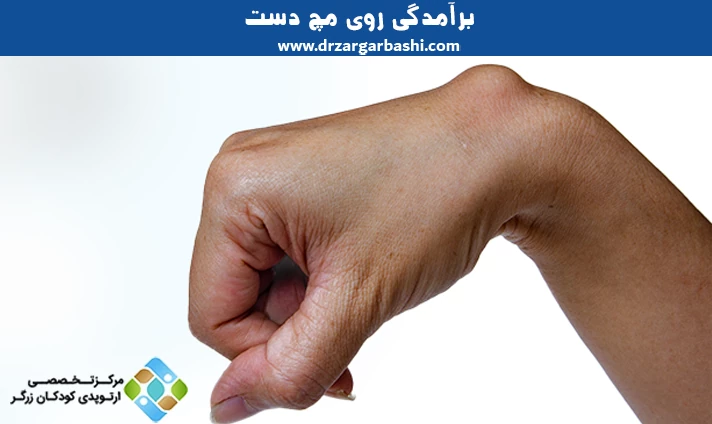 برآمدگی روی مچ دست