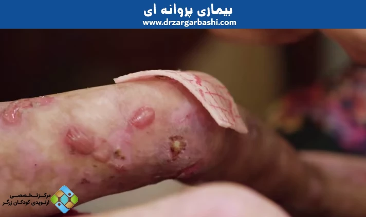 بیماری پروانه ای