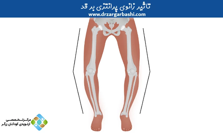 تاثیر زانوی پرانتزی بر قد