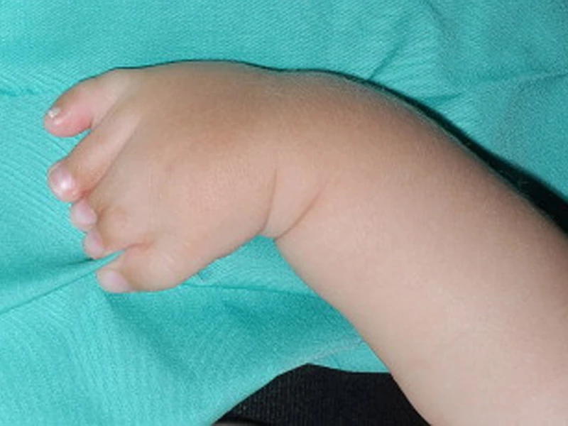 درمان ناهنجاری های مادرزادی دست نوزاد