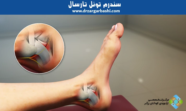 سندرم تونل تارسال