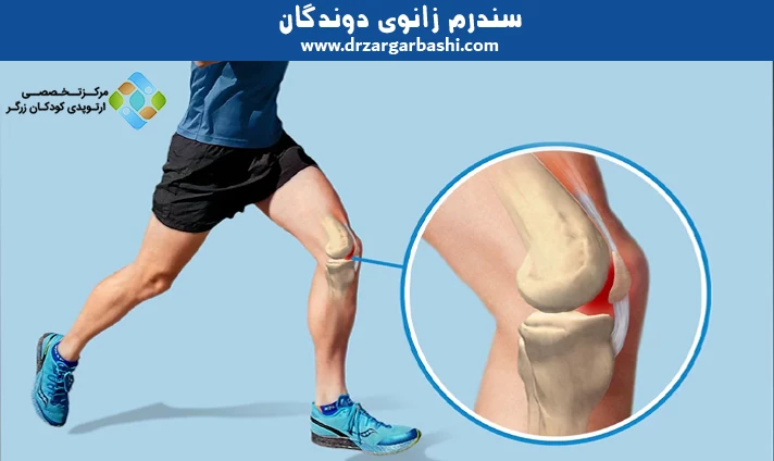 سندرم زانوی دوندگان