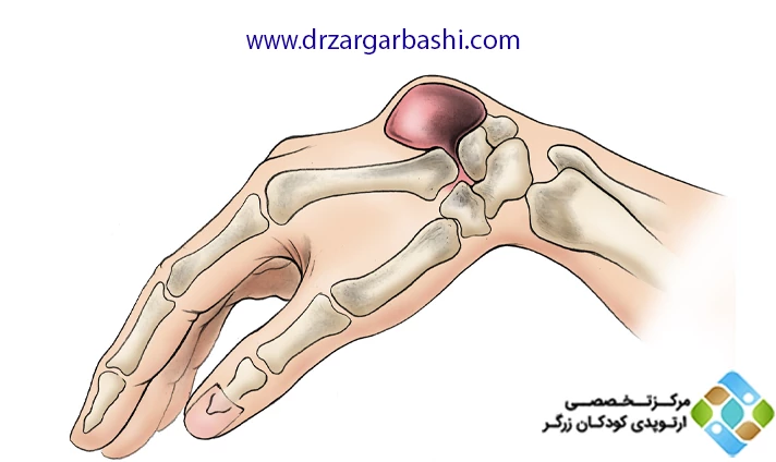 علت کیست مچ دست