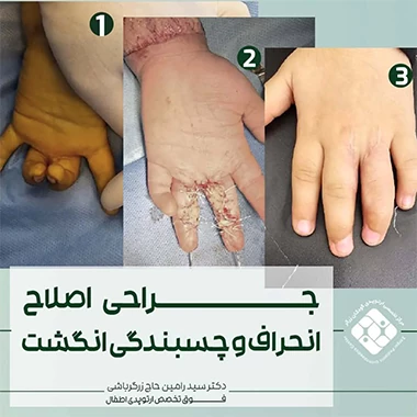ناهنجاری‌های مادرزادی دست نوزاد
