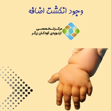 وجود انگشت اضافه از ناهنجاری‌های مادرزادی دست نوزاد