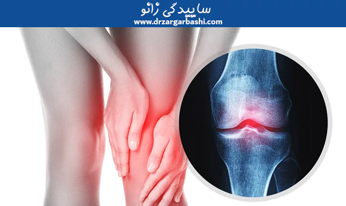 ساییدگی زانو