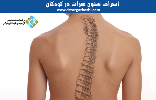 انحراف ستون فقرات در کودکان