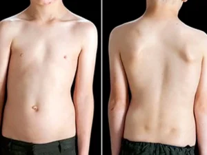 درمان انحراف ستون فقرات در کودکان