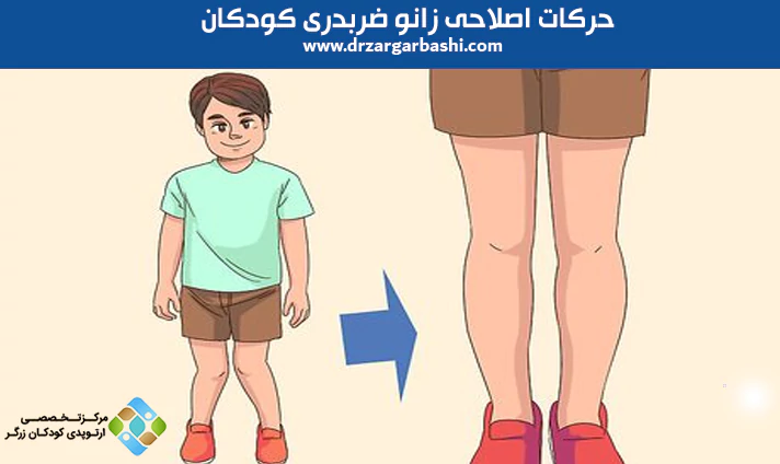 حرکات اصلاحی زانو ضربدری کودکان