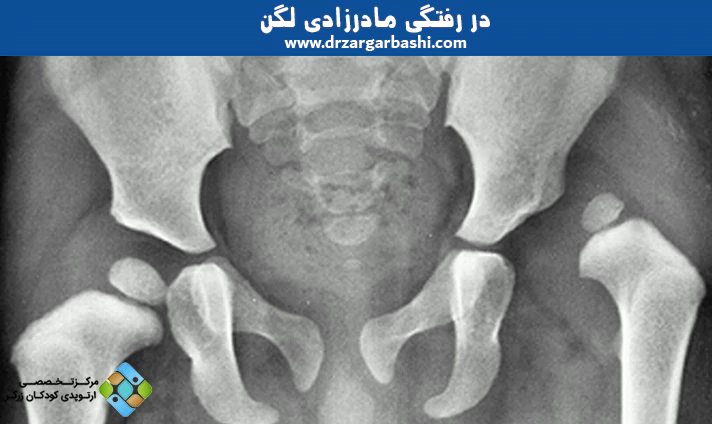 در رفتگی مادرزادی لگن
