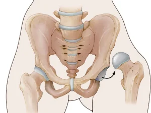 درمان در رفتگی مادرزادی لگن