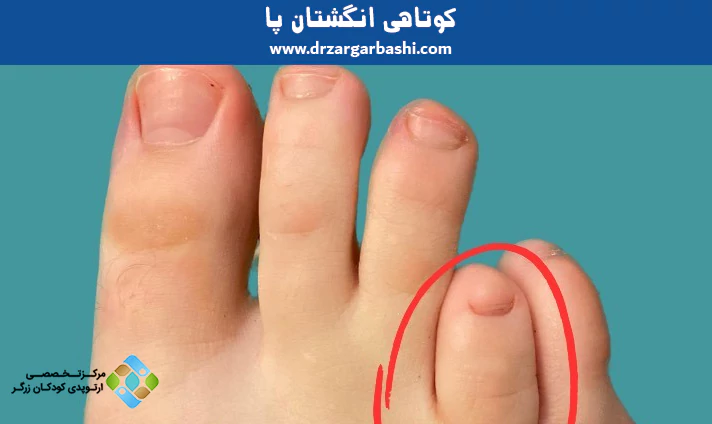 کوتاهی انگشتان پا