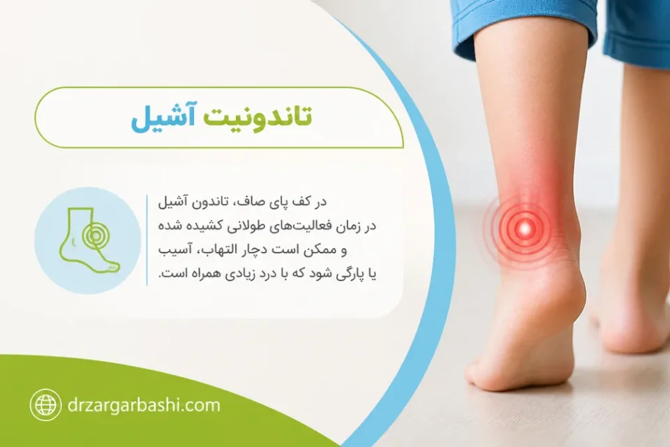نمای توضیحی درباره تاندونیت آشیل