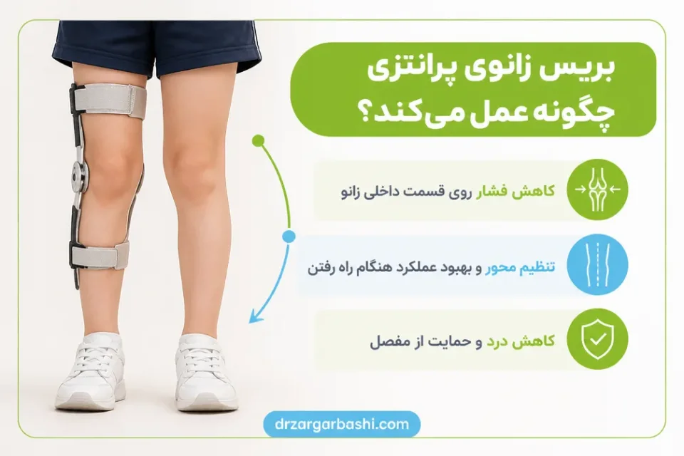 نمای توضیحی درباره بریس زانوی پرانتزی چگونه عمل میکند